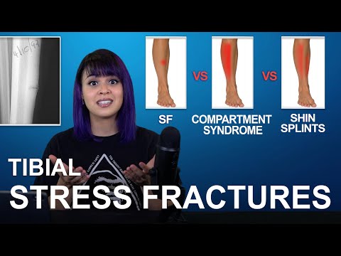 Tibial Stress Fractures: Cause, Treatment, Comparisons