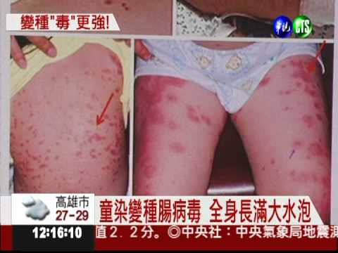 腸病毒變株 病童全身長滿水泡