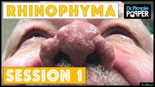 Rhinophyma treatment Session One