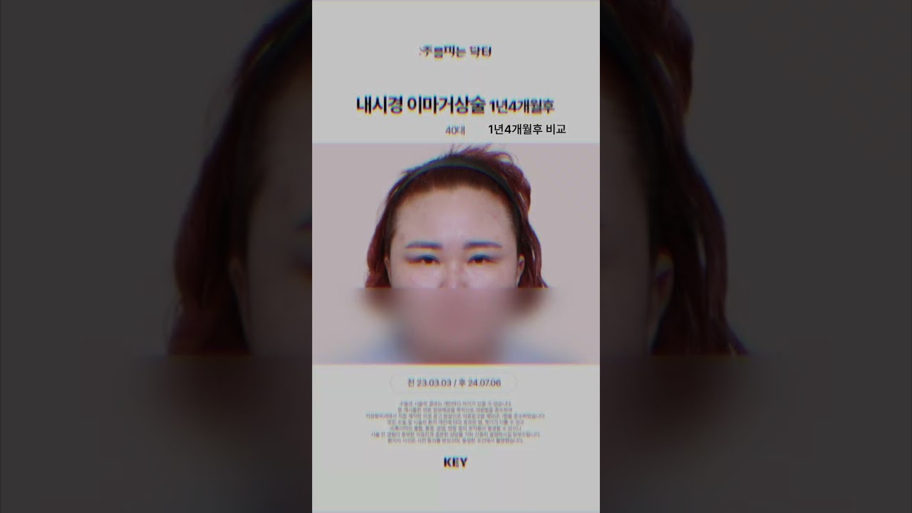 40대 이마거상술 1년4개월 후 / 대구이마거상 대구키성형외과