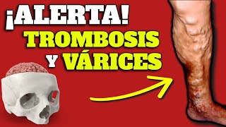 ¡ALERTA!: El PELIGRO de la TROMBOSIS y VÁRICES en las PIERNAS| PROBLEMAS DE CIRCULACIÓN