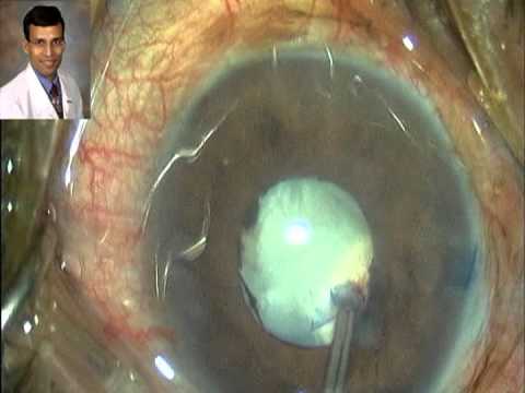 Managing Challenging Case of Traumatic Cataract