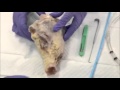 Scalpel Finger Bougie Cricothyrotomy