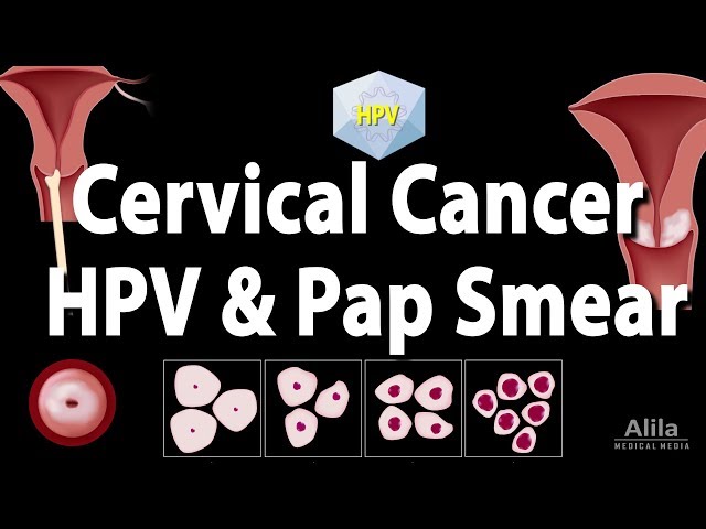 Wymowa wideo od cervical cancer na Angielski