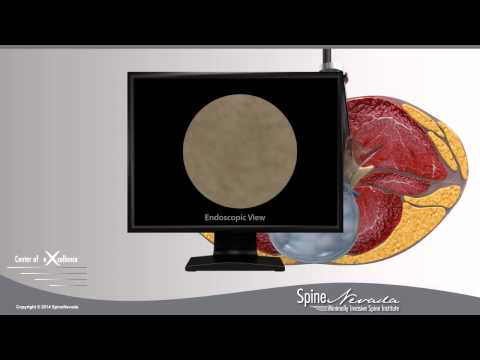 Endoscopic Microdiscectomies, Reno, Sparks, Carson City, Sacramento, Northern Nevada - SpineNevada