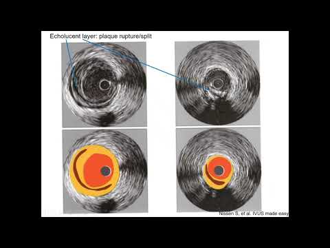 Intravascular ultrasound (IVUS) - Elias Hanna, Univ of Iowa