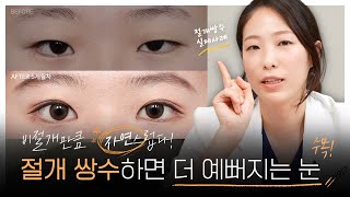 절개 쌍수가 이렇게 자연스럽다고?! | 제이티성형외과 유하현원장