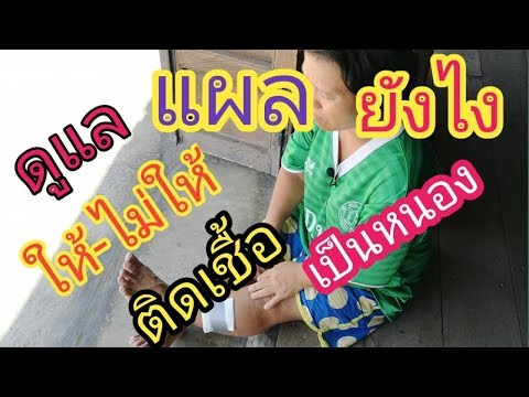 โรคสะเก็ดเงินในเด็ก 4 มกราคม ช่วยคน polisorb ในโรคสะเก็ดเงิน