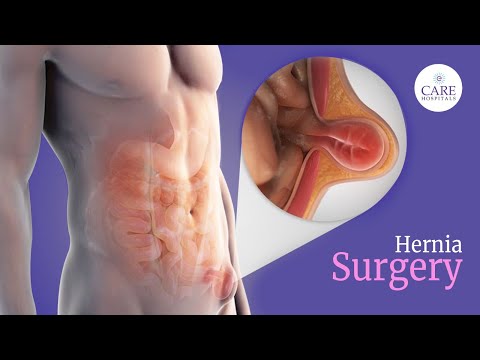 Laparoscopic Inguinal Hernia Repair | Hernia Surgery | CARE Hospitals