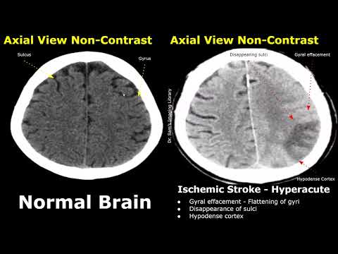CT Scan Brain Normal Vs Ischemic Stroke Images | Non-Contrast Hyperacute/Acute/Chronic Infarction