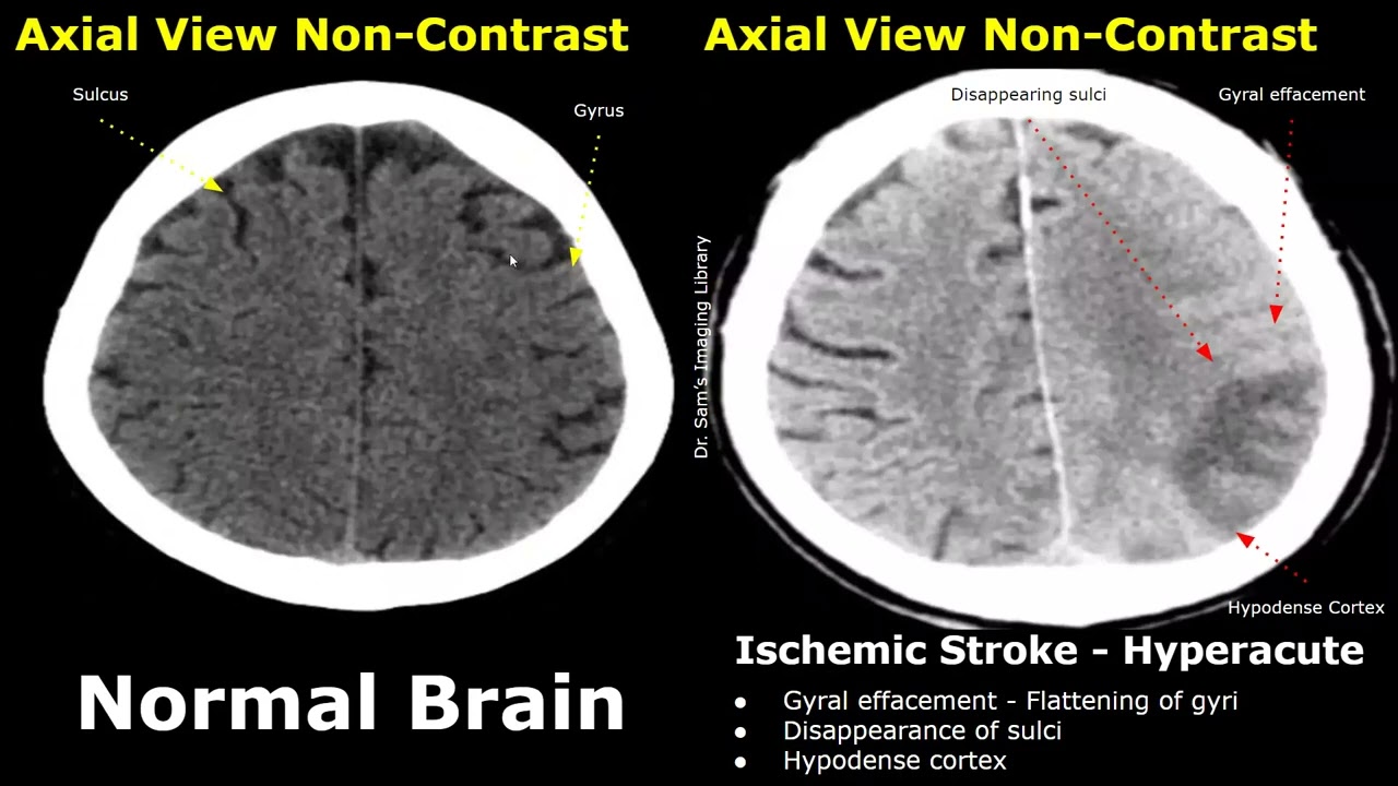 CT Scan Brain Normal Vs Ischemic Stroke Images | Non-Contrast Hyperacute/Acute/Chronic Infarction
