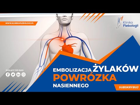 EMBOLIZACJA ŻYLAKÓW POWRÓZKA NASIENNEGO - jak przebiega zabieg?