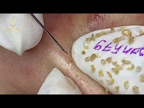 Loan Nguyen Acne Treatment (#135)