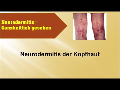 Machen Massage bei der Schuppenflechte Die Schuppenflechte das Forum kitaj die Behandlung