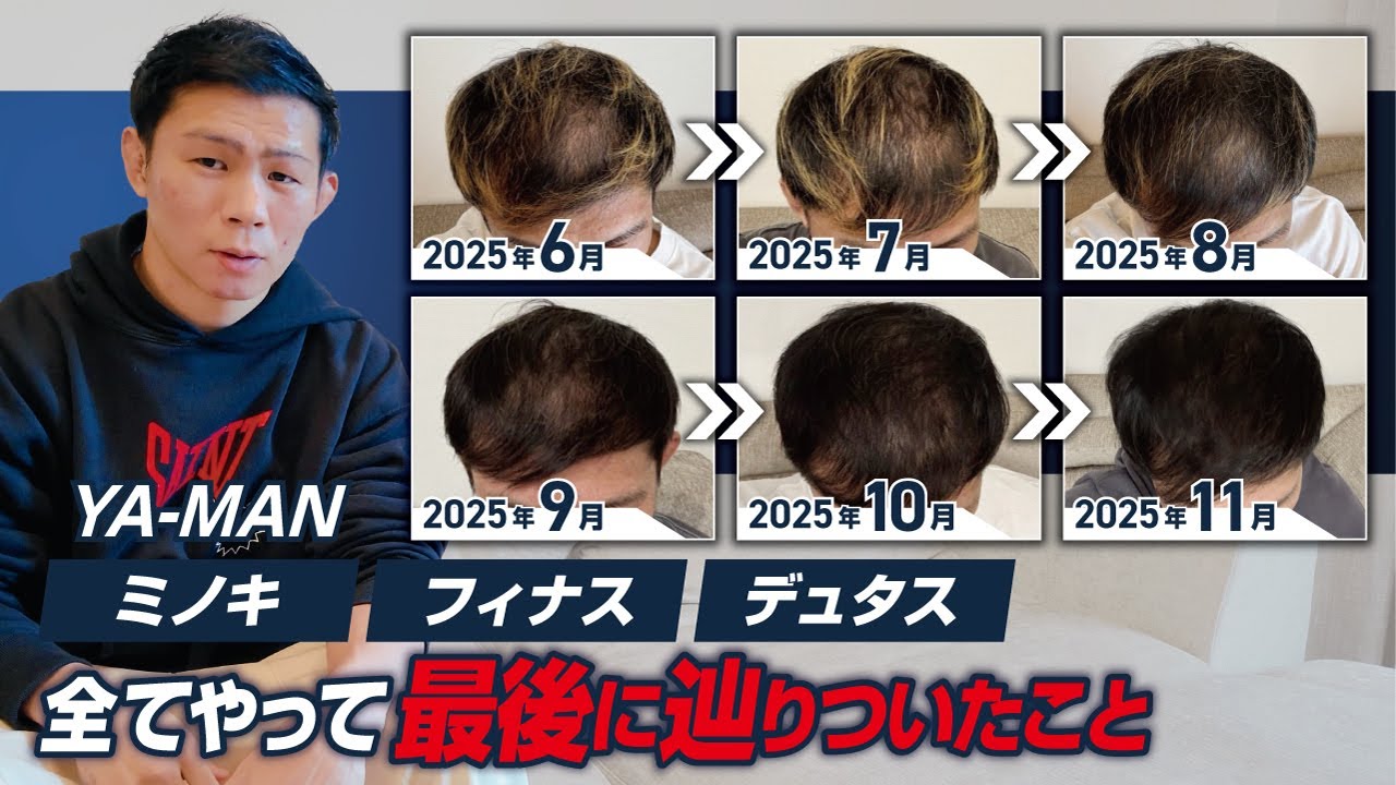 髪を増やす為にやった事を話ました