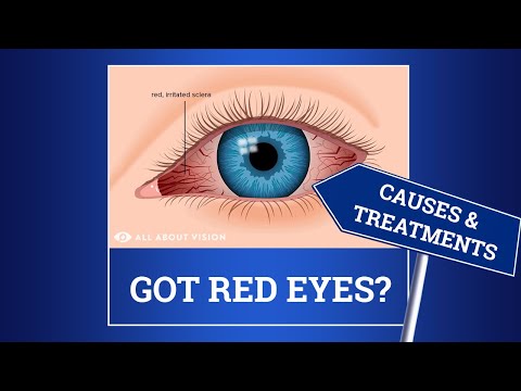 Red Eyes and Bloodshot Eyes: Causes and Treatments
