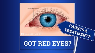 Red Eyes and Bloodshot Eyes: Causes and Treatments