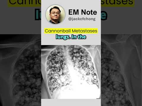 Cannonball Metastases in Osteosarcoma