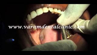 preview picture of video 'Part 2-Regaining Lost Vertical Height By Implants By Increasing The Facial Height-VaRam Dental-VNR'