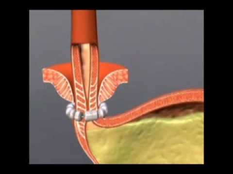 Using LINX to Treat GERD at Stony Brook Medicine