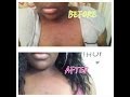 Dark Spots on African American Skin.. BEFORE ...