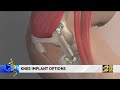 Knee implant options