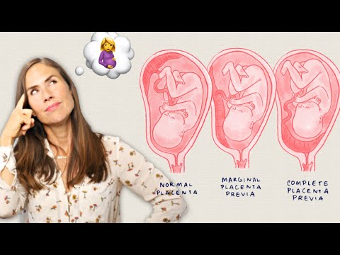 Placenta praevia: Ist eine natürliche Geburt noch möglich?