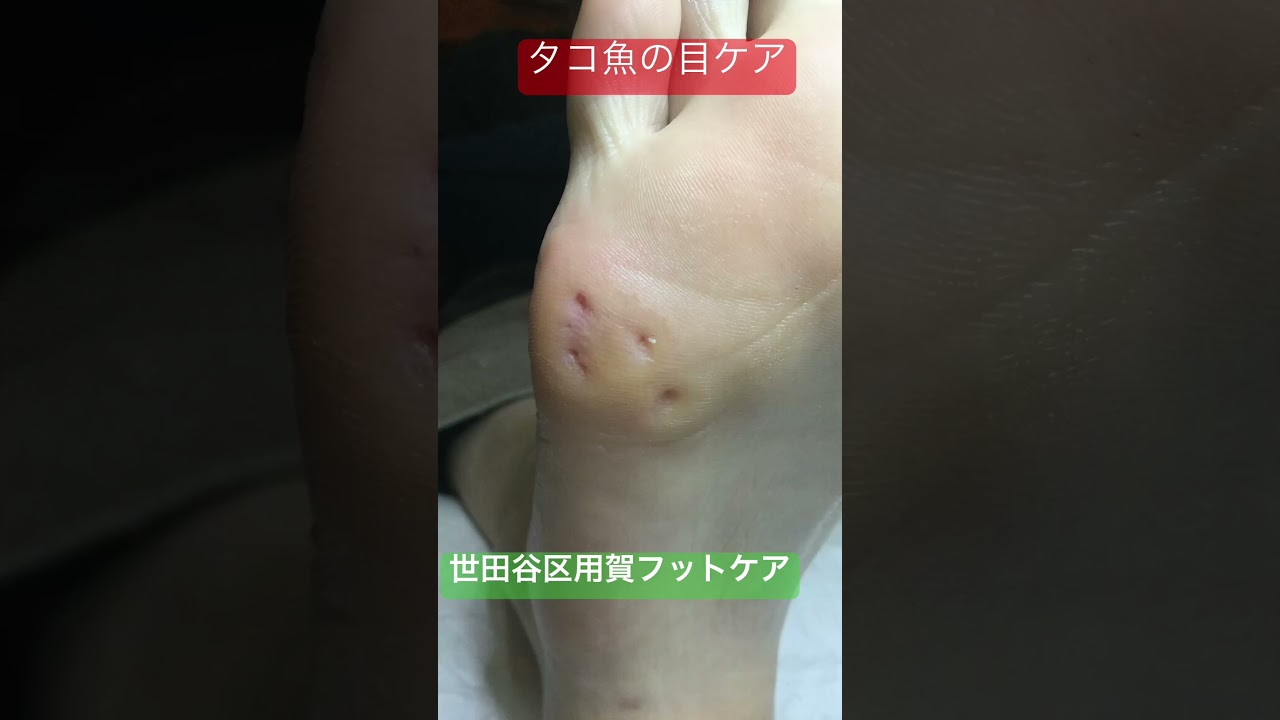 タコ魚の目ケア