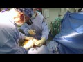 Minimally Invasive Bypass A Better Way Sanger Heart Vascular Institute