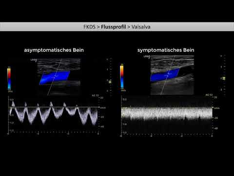 Kompressionssonographie der Beinvenen - Teil 2: Exkurs FKDS und Flussprofil