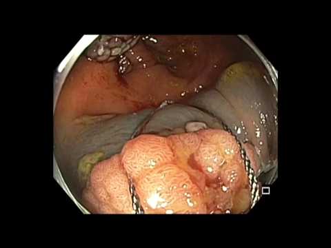Colonoscopia - colon ascendente - RME grande