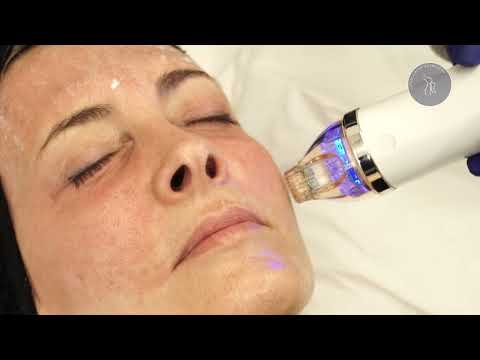 Beneficios del Secret RF Facial