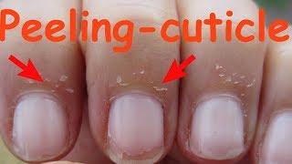 How to care for Skin Peeling near Nails ? D.I.Y 4 #30days30diy