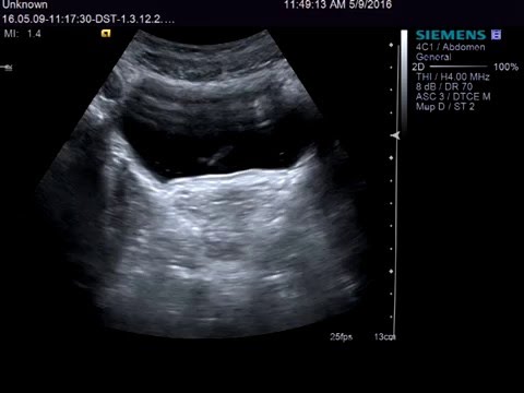 Welche Tests müssen Sie in Prostata-Entzündung passieren Heimtrainer und seine Auswirkungen auf die Prostata