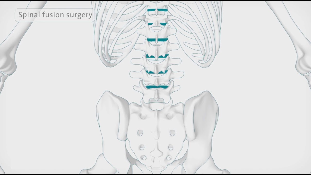 How back surgery (spinal fusion) is performed | Spire Healthcare