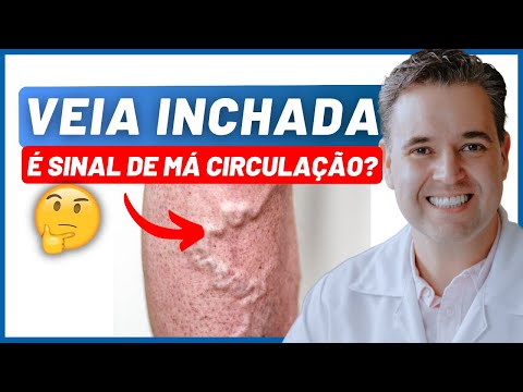 Swollen vein in the leg, is it a sign of poor circulation? - Dr. Alex Vascular