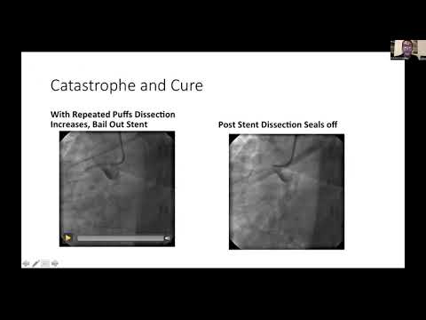 CTO Complications: How Should We Tackle?