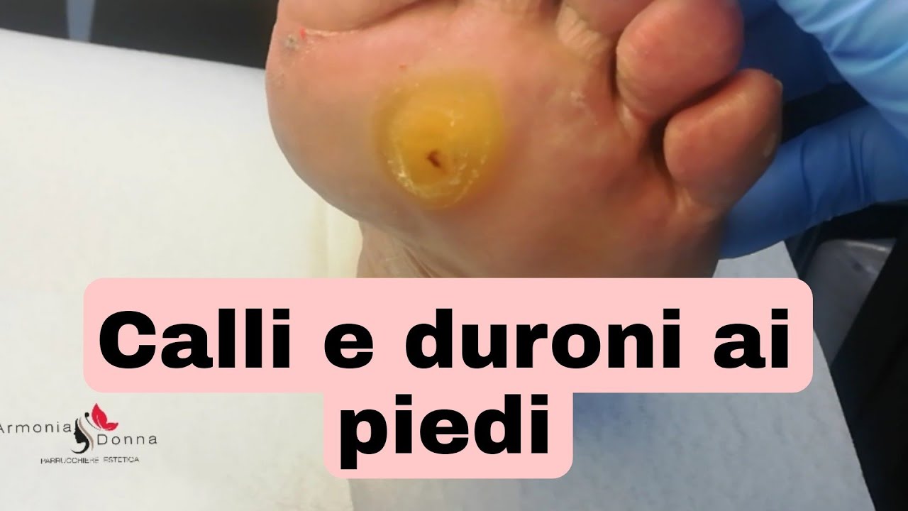 [Calli e duroni ai piedi] #ArmoniaDonna #Grazia #santangelo