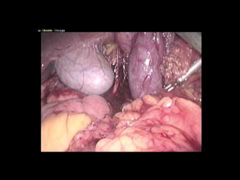 Laparoscopic Pancreas-Preserving Resection For Duodenal Adenocarcinoma