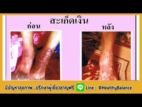 อาการกลากเช่นส่ง กับร้องไห้กลากบนผิวระหว่างการเปลี่ยนแปลงการเปลี่ยนแปลงต่อไป