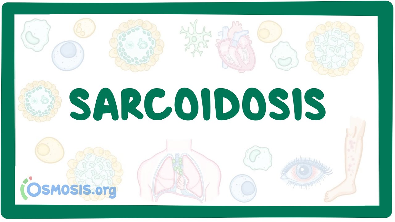 Sarcoidosis - causes, symptoms, diagnosis, treatment, pathology
