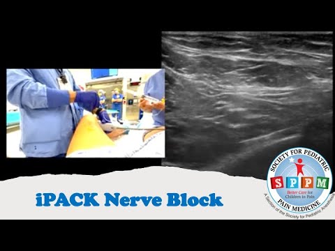 iPACK Nerve Block
