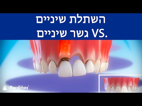 © השתלת שיניים / גשר שיניים – השוואה