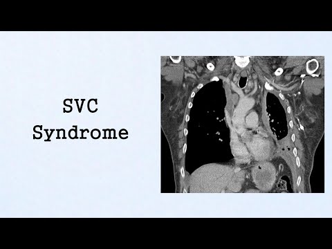 Tumor Lysis Syndrome Oncologic Emergencies