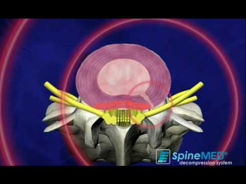 Zervikale Osteochondrose in 15 Jahren 4-5 Osteochondrose herniated Wirbelsäule zu behandeln
