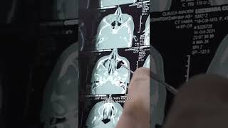 Como é a sinusite vista pelo Raio-X