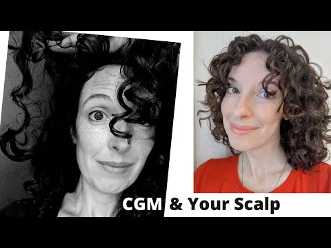 Can You Follow the Curly Girl Method with Seborrheic Dermatitis? Fix Your Itchy Oily Scalp