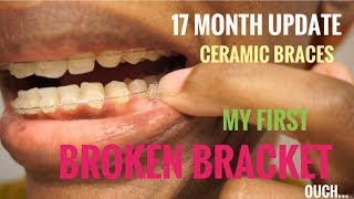 I Broke a Bracket | Ceramic Braces Update