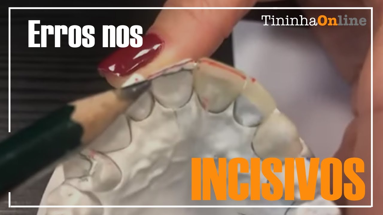 AULA #1 Erros nos Incisivos