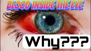 Can you have bleeding inside the eye?? Vitreous haemorrhage revealed
